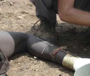 A guinea worm emerges from the leg of a South Sudanese girl in Juba.
